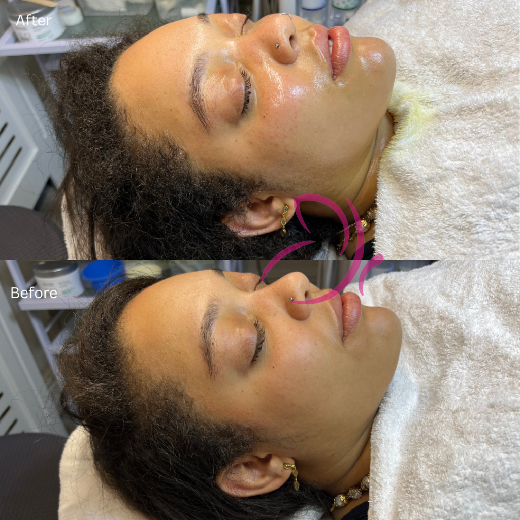 Had a hydrafacial treatment with Lilian, and my face is definitely less tight and a lot more hydrated. The venue is clean and knowing that she is also a registered nurse makes me feel a lot more a