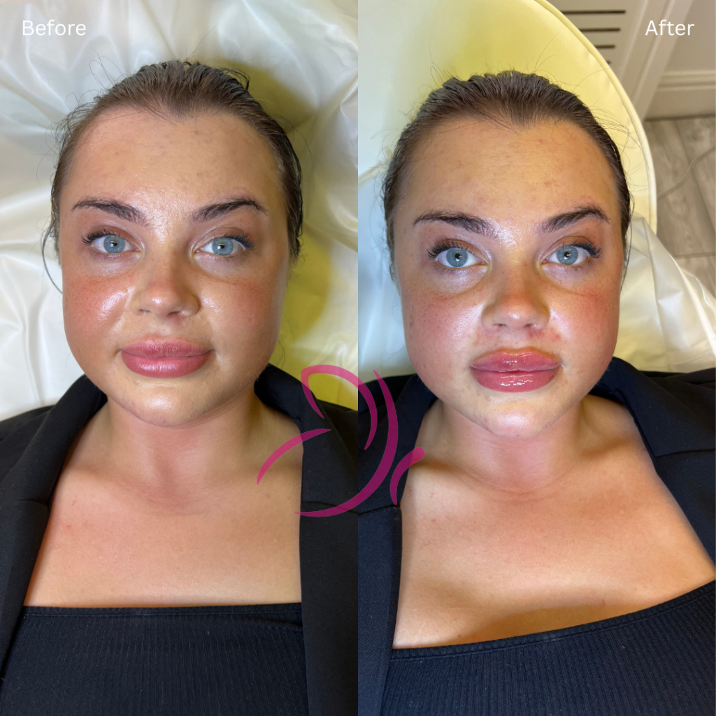 Had a hydrafacial treatment with Lilian, and my face is definitely less tight and a lot more hydrated. The venue is clean and knowing that she is also a registered nurse makes me feel a lot more a-2