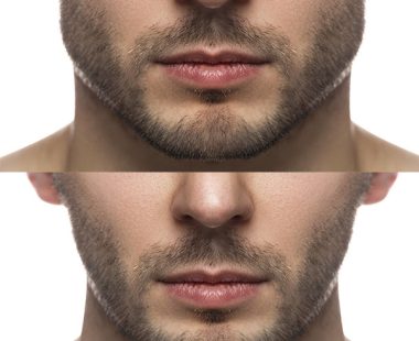 SarasinClinic_bruxisme-tandenknarsen-behandeling SarasinClinic_bruxisme-tandenknarsen-behandeling