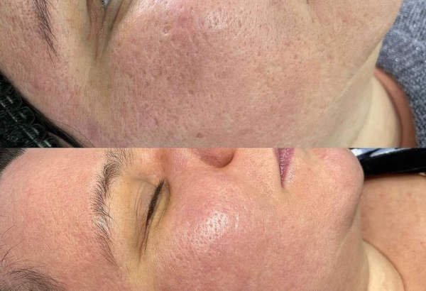 undefined (10) Oil Control and Sebum Regulation