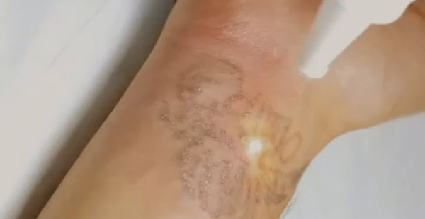 undefined (10) Scar Revision After Tattoo Removal