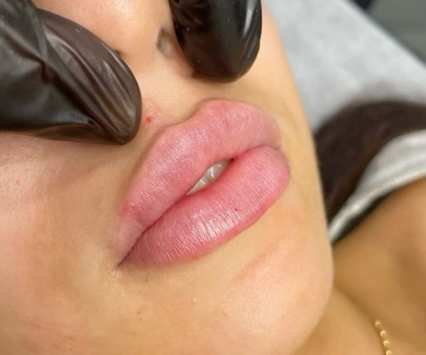 undefined (11) Lip Filler Treatment