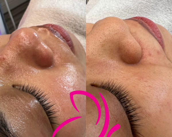 undefined (5) Acne Treatment