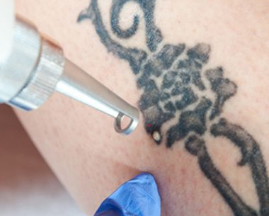 undefined (5) Expert Laser Tattoo Removal