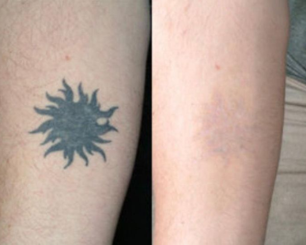 undefined (6) color Tattoo Removal in Manchester