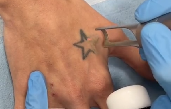 undefined (7) Expert Laser Tattoo Removal in Manchester
