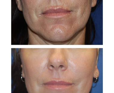 undefined (8) Fine Lines and Wrinkles Reduction