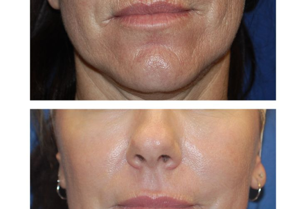 undefined (8) Fine Lines and Wrinkles Reduction